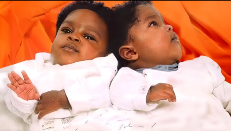 These Black Conjoined Twins Were Separated at Birth. This Is How They ...